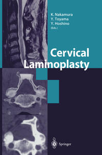 Cervical Laminoplasty