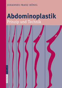 Abdominoplastik