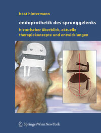 Endoprothetik des Sprunggelenks